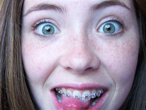 brace face nude|Braces Hot Nude Girls